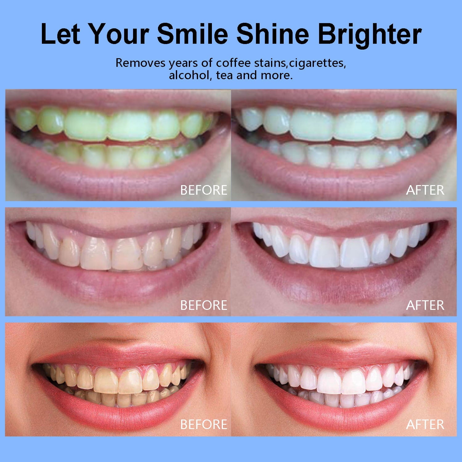 LED Teeth Whitening Kit ( Upgraded Version )